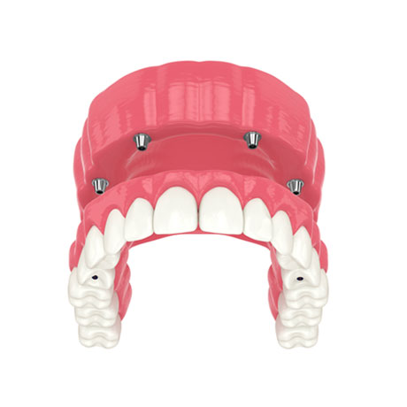 Full Arch Implants