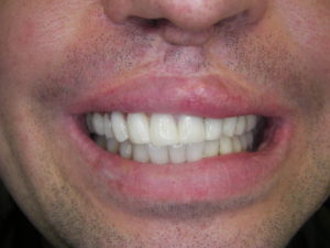 Veneers after placement