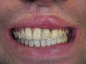 porcelain veneers before