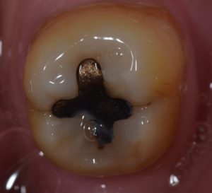 amalgam filling