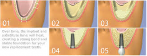 internal sinus lift