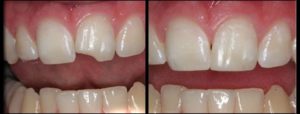 cosmetic bonding