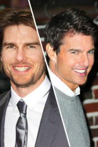 tom cruise braces