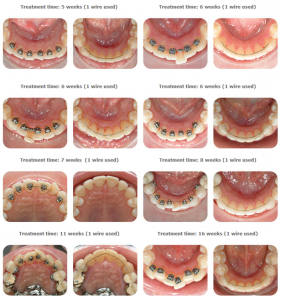 Lingual Braces Glasgow