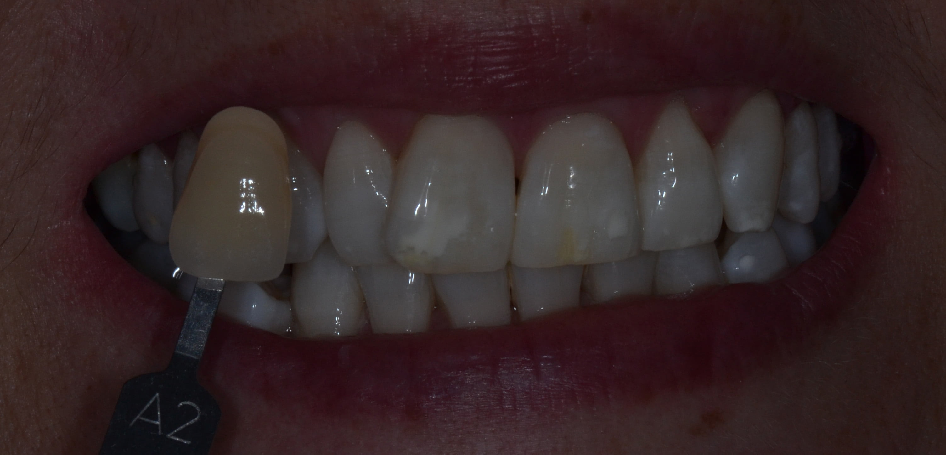 Enlighten tooth whitening Glasgow Cosmetic Dentist Glasgow