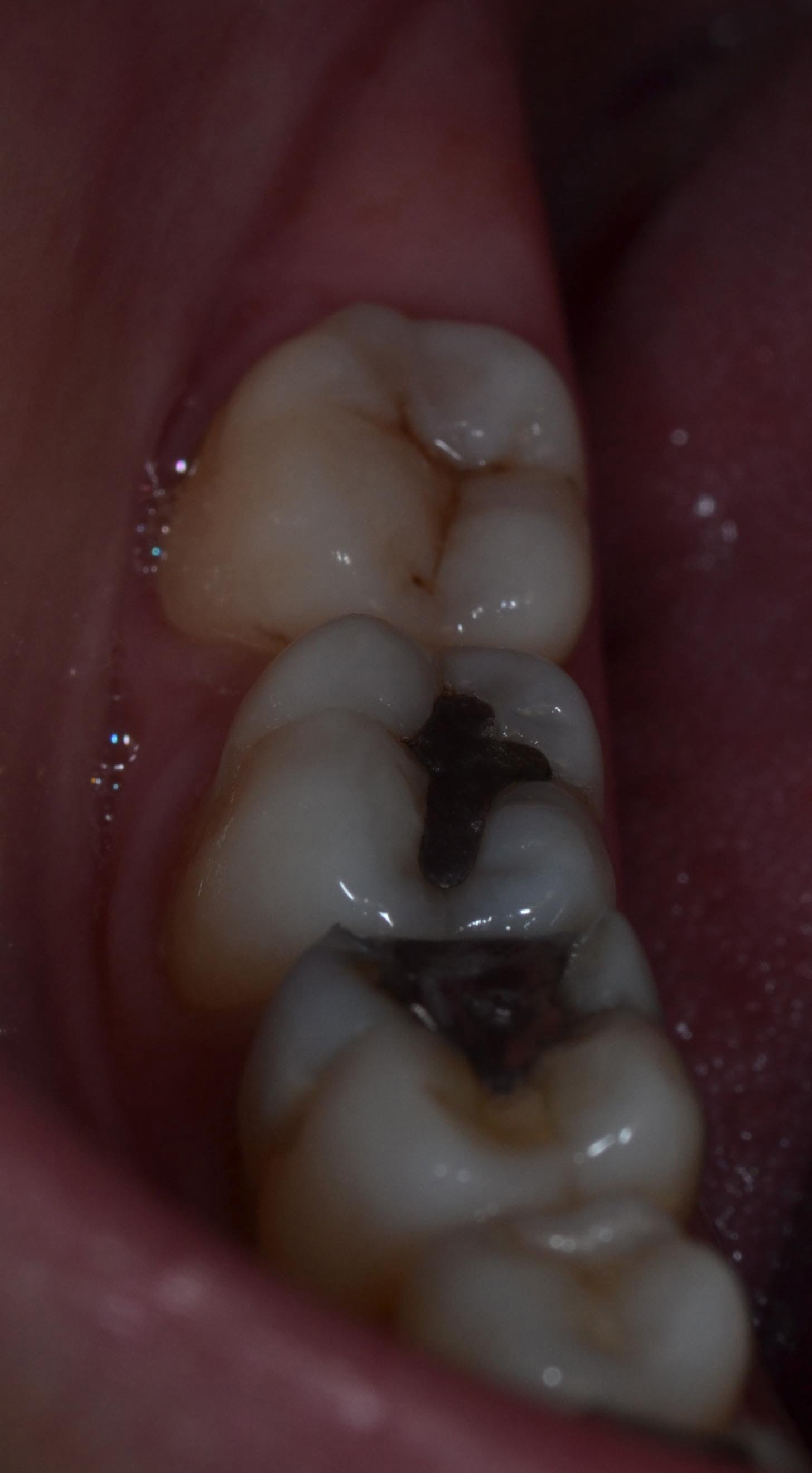 Cosmetic white fillings Cosmetic Dentist Glasgow