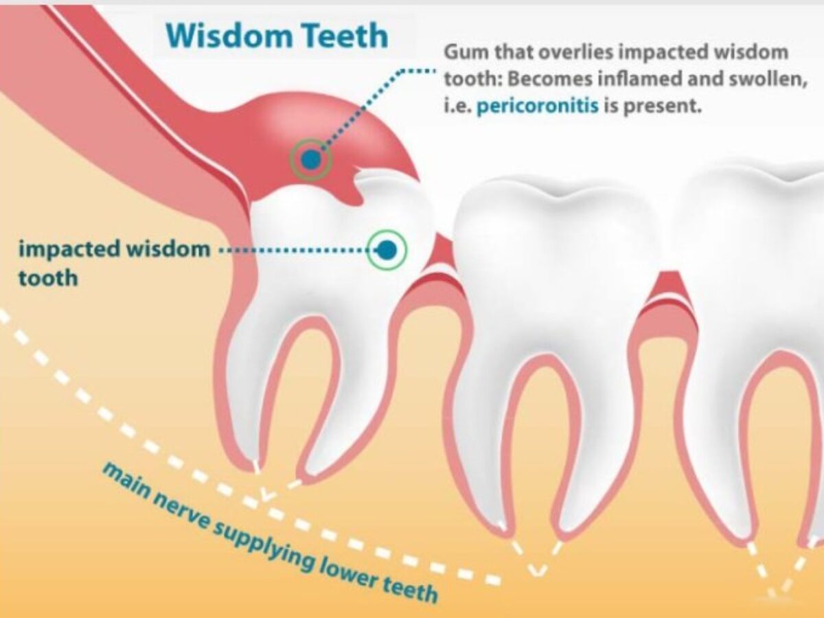 Wisdom Tooth Pain Glasgow | Cosmetic Dentist Glasgow